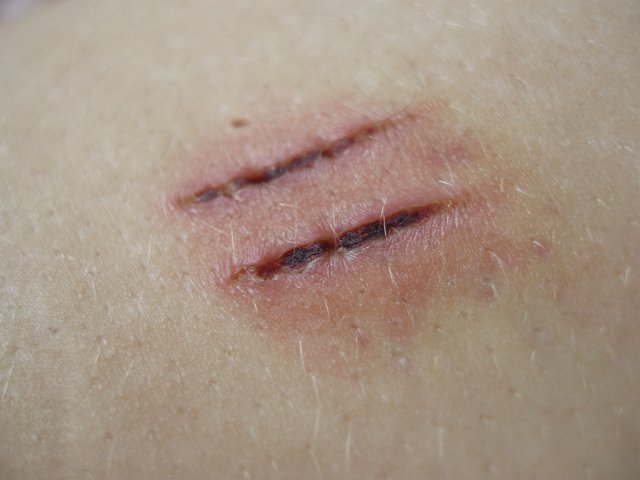 scabs on previously grazed skin