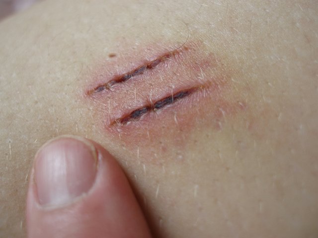 scabs on previously grazed skin